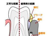 歯周病