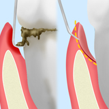 歯周ポケットそうは術