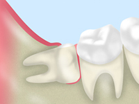 親知らずがもたらす症状